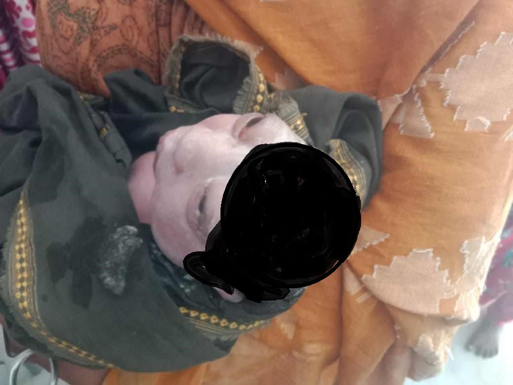 কার্পাসডাঙ্গায় মাথার খুলিবিহীন শিশুর জন্ম